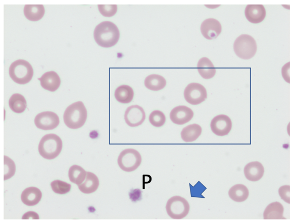 Iron Deficiency Anemia • The Blood Project