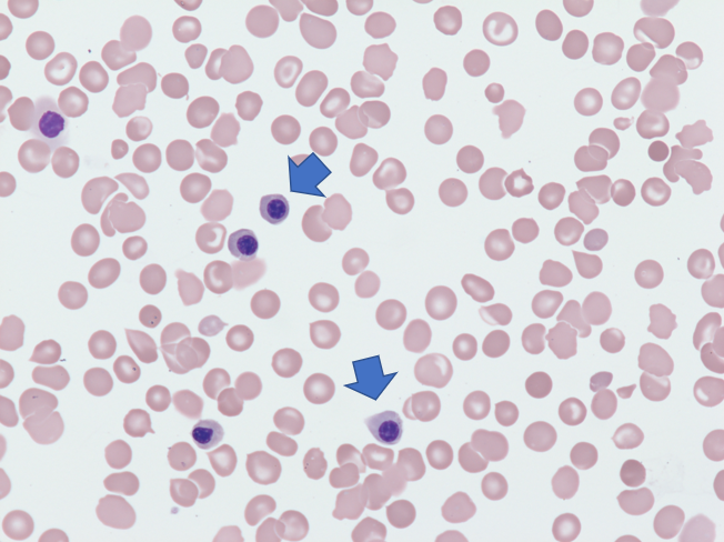 Nucleated red blood cells (two are shown with blue arrow) in neonatal blood (50x, oil).