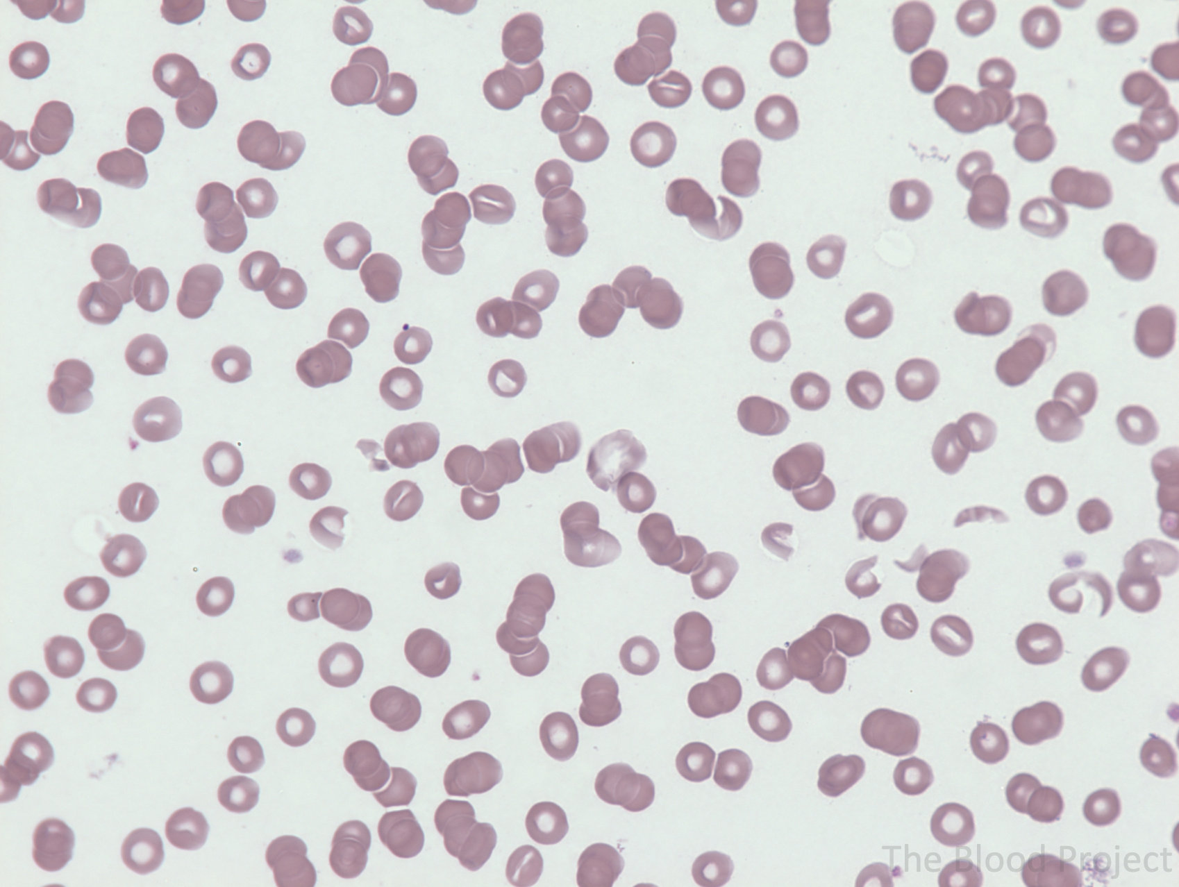 True Rouleaux Rbc Rouleaux • The Blood Project