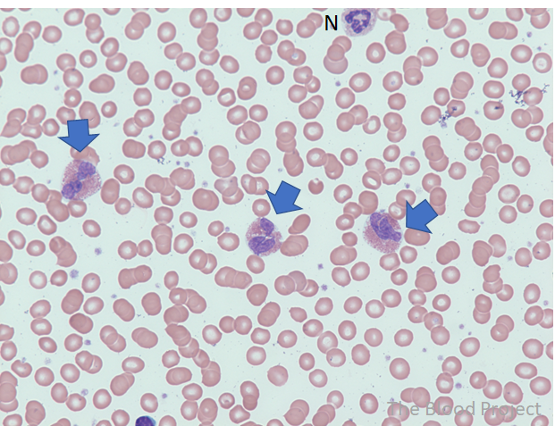 Eosinophils