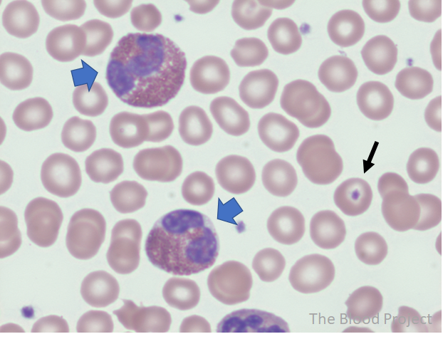Eosinophils Vs Neutrophils Eosinophils Vs Neutrophils