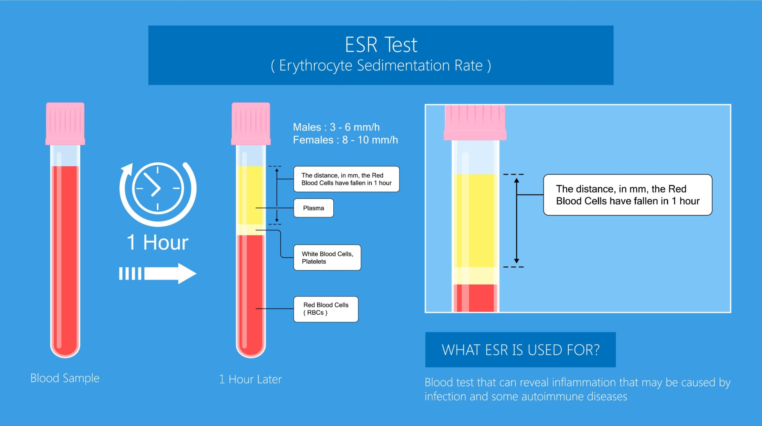 What is the erythrocyte sedimentation rate (ESR)? • The Blood Project