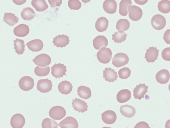 What is a burr cell? • The Blood Project