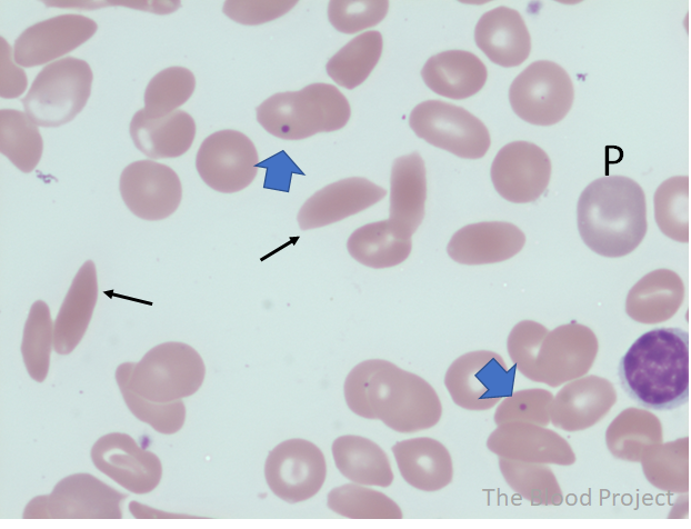 Sickle Cells The Blood Project