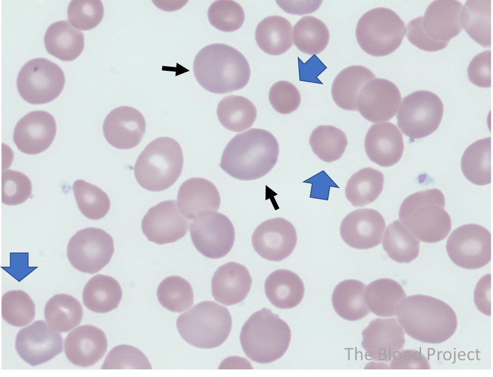 multiple elliptocytes (blue arrows) (100x,