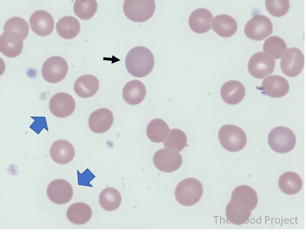 multiple elliptocytes (blue arrows) (100x,