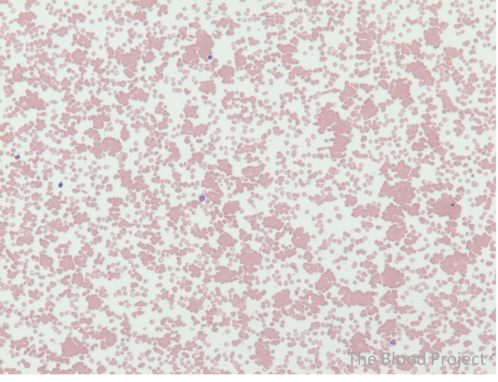 Cold Agglutinin Disease • The Blood Project