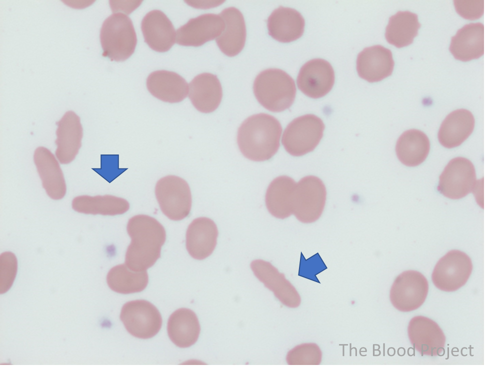The blood film from a patient with hereditary elliptocytosis shows multiple elliptocytes (blue arrows) (100x, oil).