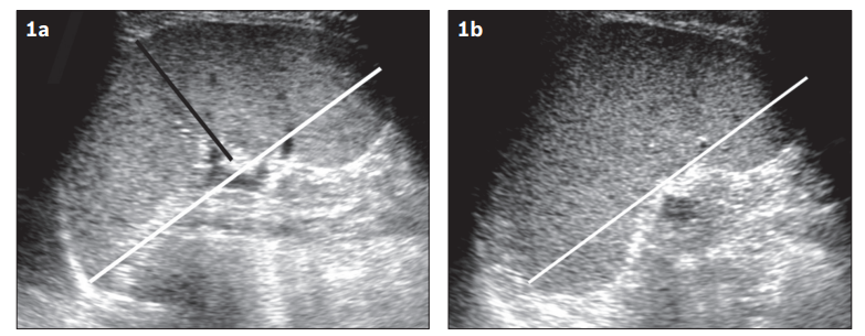 normal and enlarged spleen