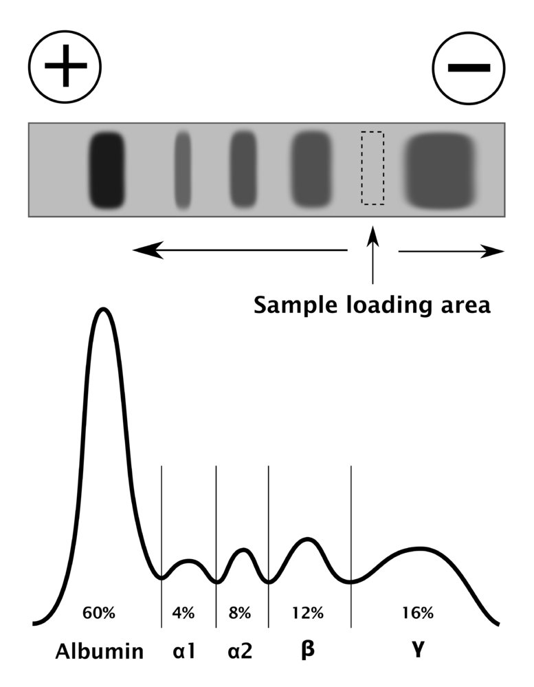 Polyclonal Gammopathy_POSTCRIPT • The Blood Project