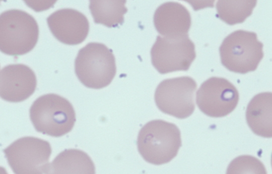 Case of Anemia and Thrombocytopenia • The Blood Project
