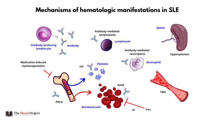 Sle Gen SLE and Hematology • The Blood Project