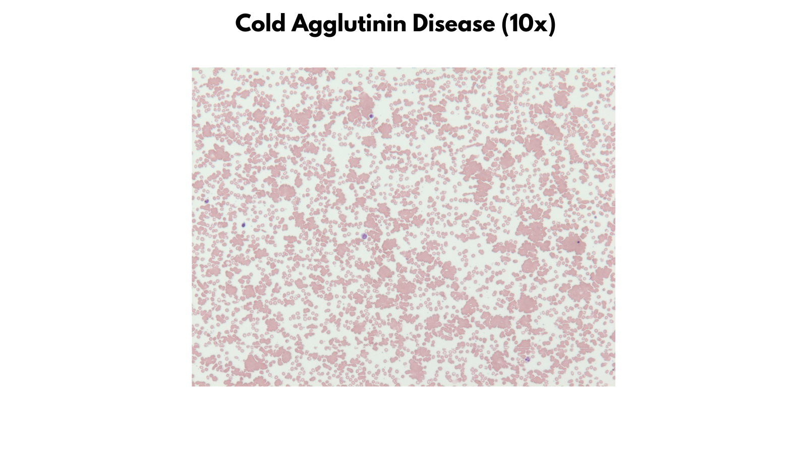 Hemolytic Anemias • The Blood Project