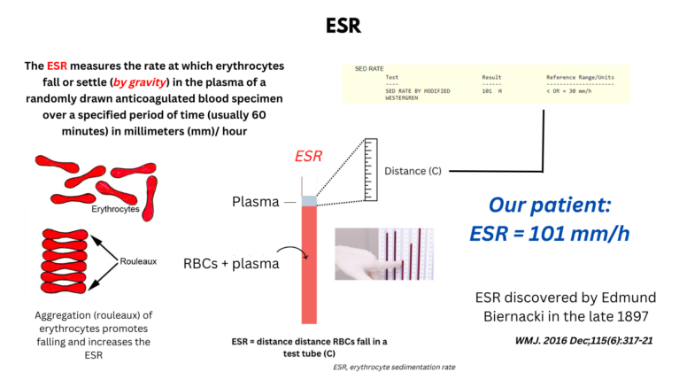 Erythrocyte Sedimentation Rate The Blood Project erythrocyte-sedimentation-rate-the-blood-project