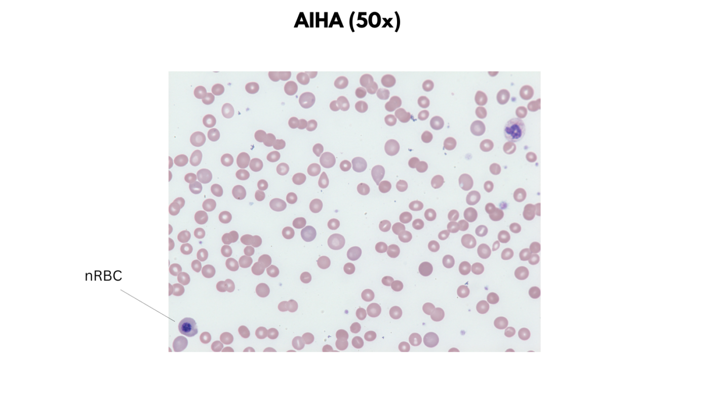 Hemolytic Anemias • The Blood Project
