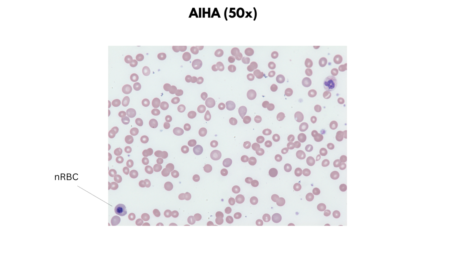 Hemolytic Anemias • The Blood Project