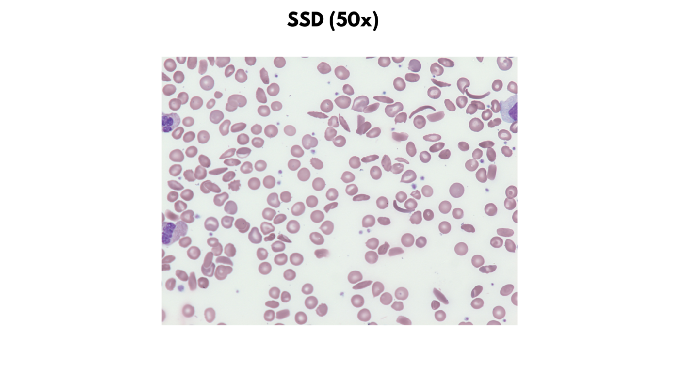 Hemolytic anemias the blood project
