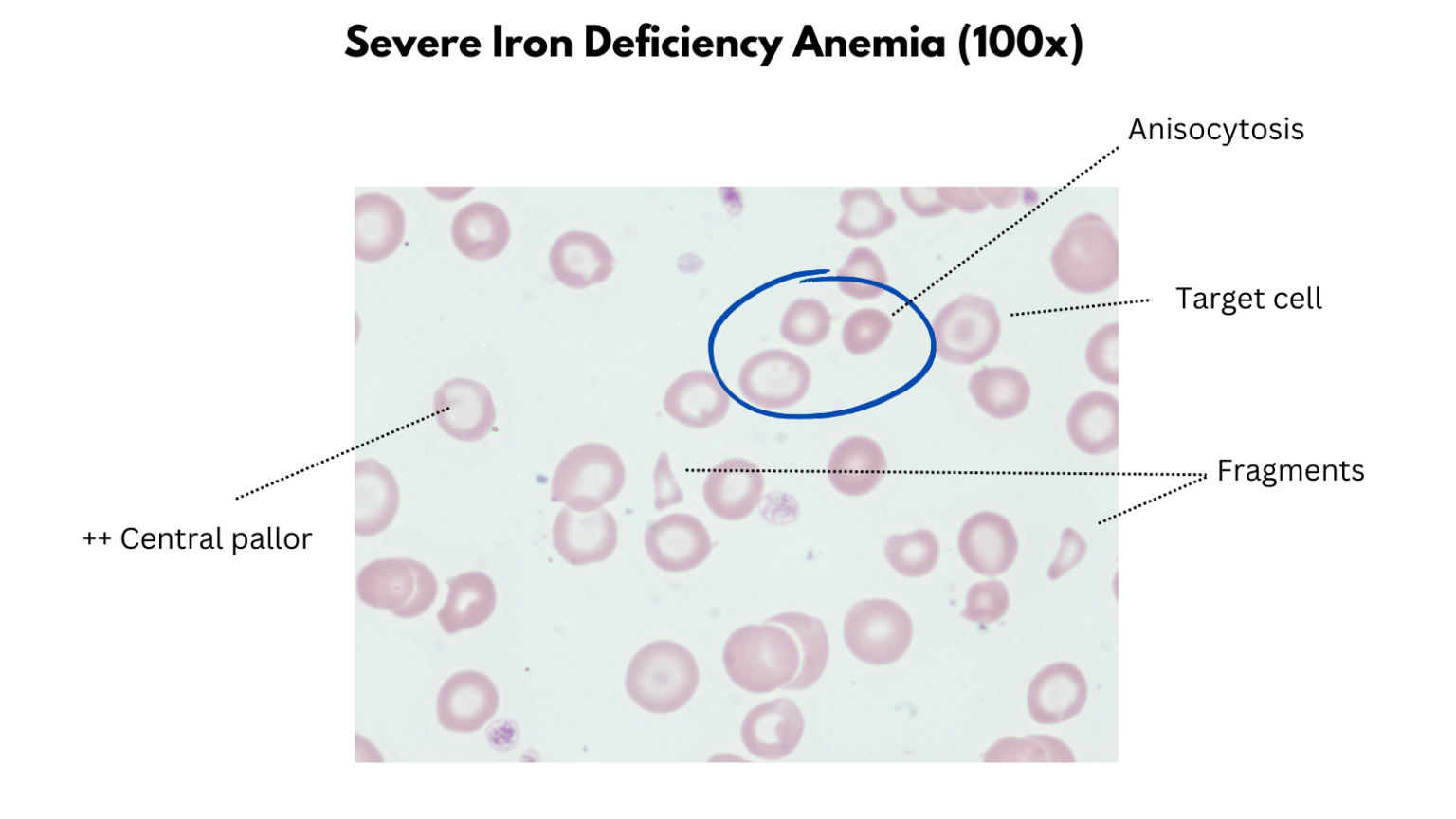 Microcytic Anemias • The Blood Project