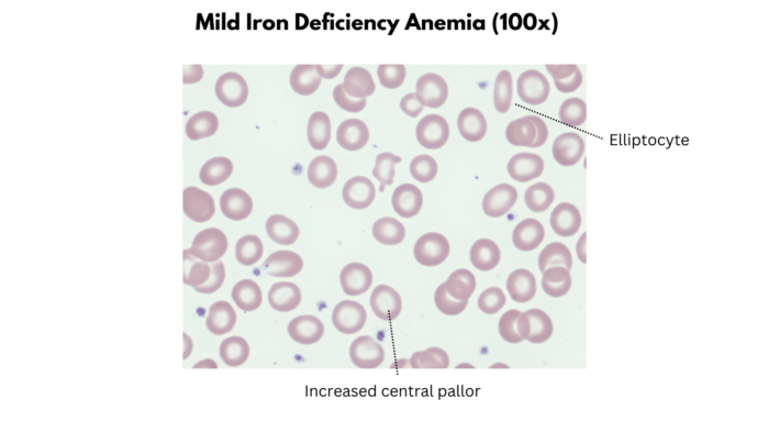 Microcytic Anemias • The Blood Project