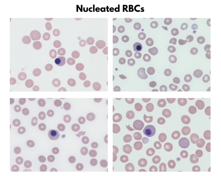 Red Blood Cell Inclusions • The Blood Project