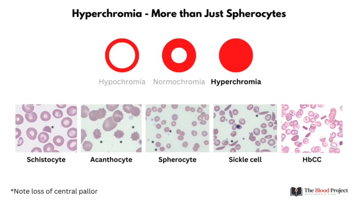 What Does Slight Polychromasia Mean Red Cell Staining (Color) • The Blood Project