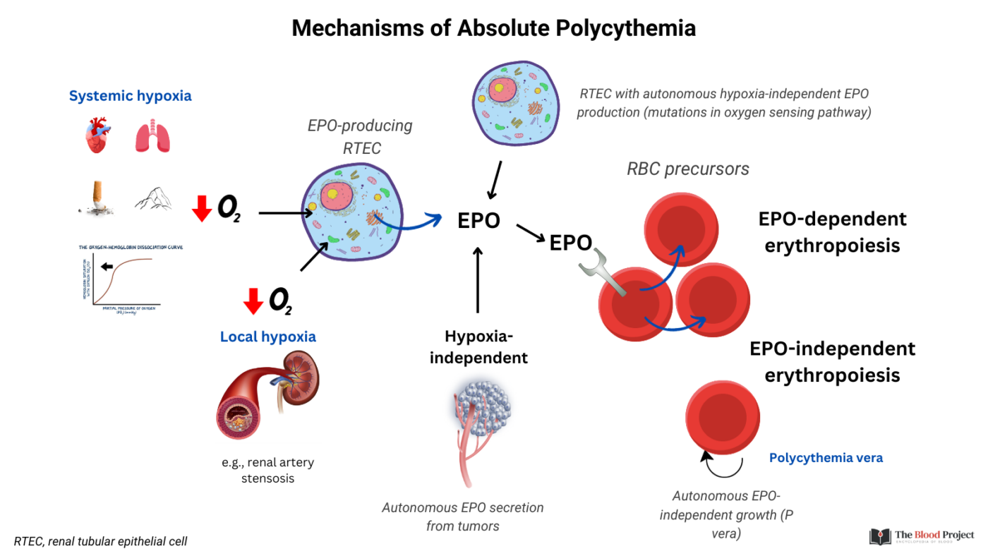 Classification of absolute polycythemia the blood project