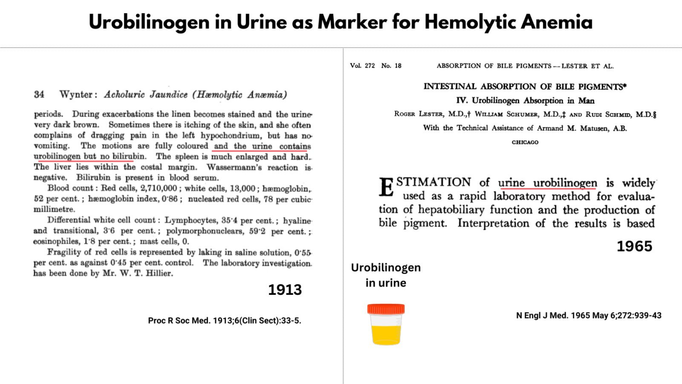 Urobilinogen in hemolytic anemia the blood project