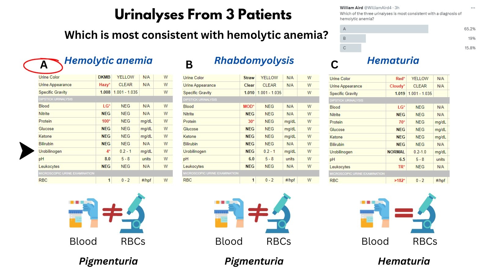 Urobilinogen in hemolytic anemia the blood project