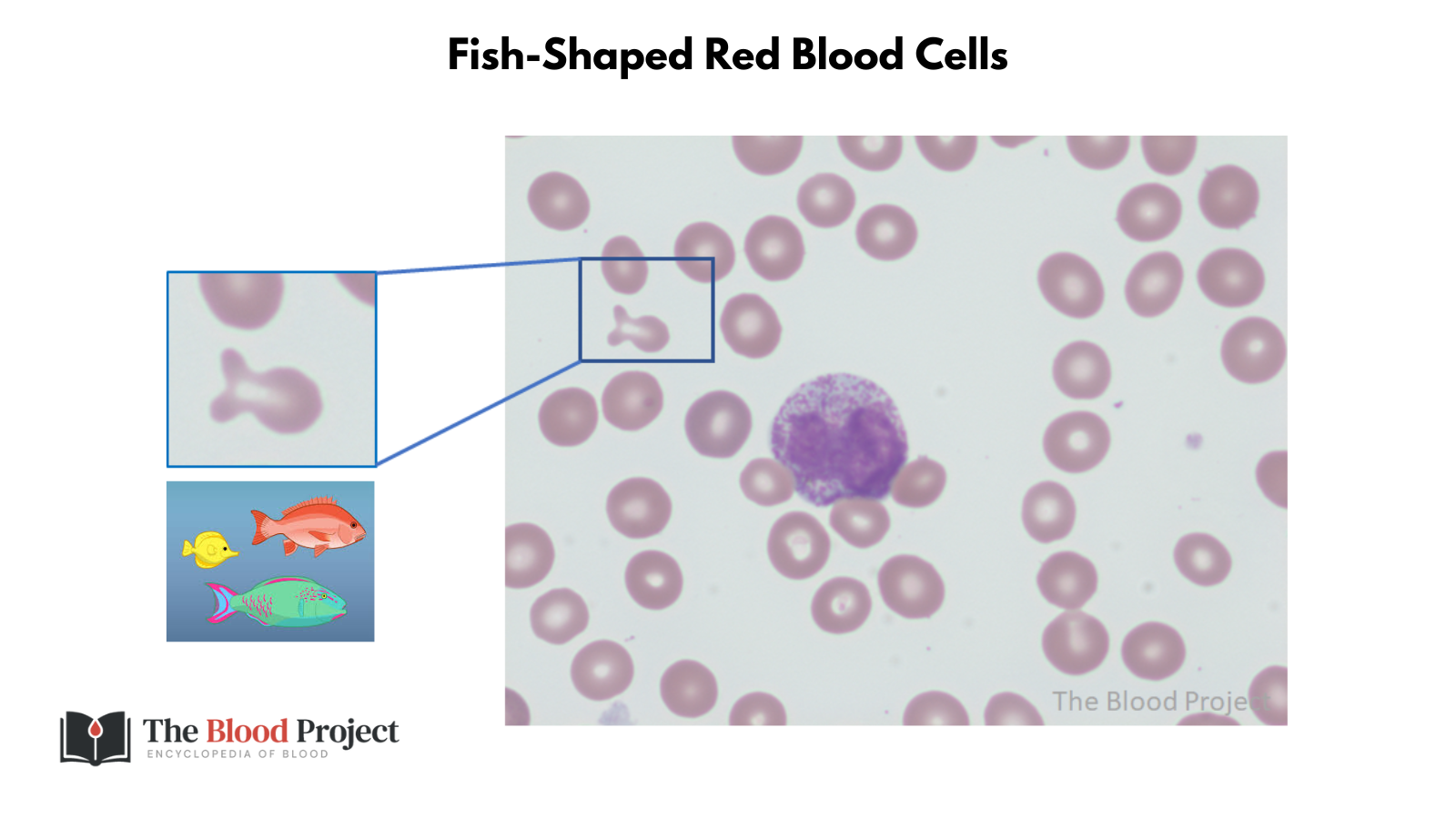 Fish-Shaped Red Blood Cells • The Blood Project