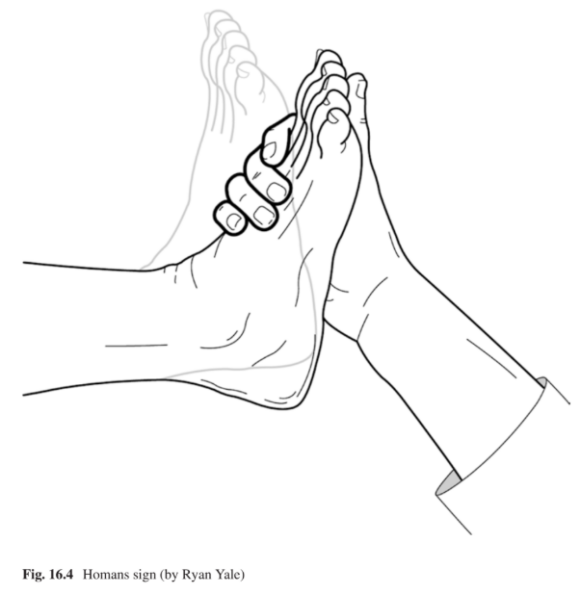 Eponymic Physical Signs in Deep Vein Thrombosis • The Blood Project