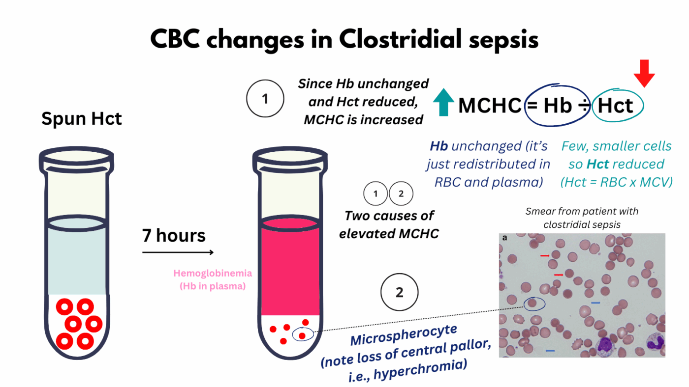 Clostridial Sepsis • The Blood Project